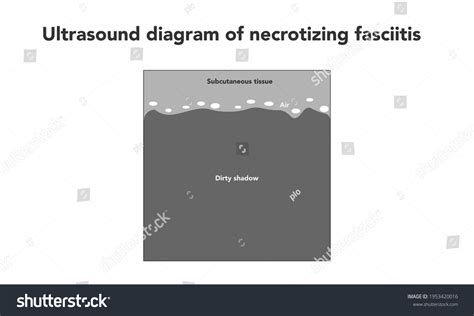 Ultrasound Diagram Necrotizing Fasciitis Stock Vector Royalty Free 1953420016 Shutterstock