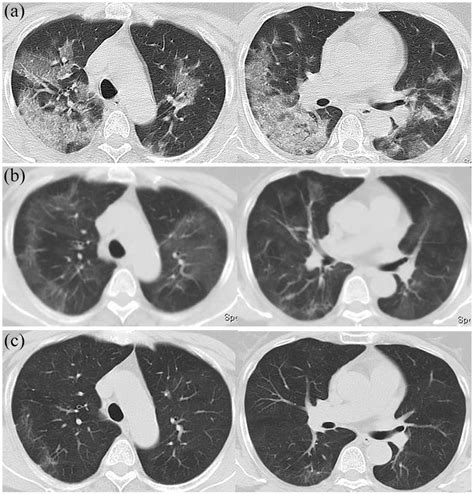 Chest CT images of patient with COVID-19 in hospital and 1 and 3 months... | Download Scientific ...