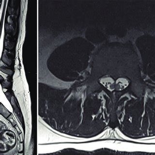 Preoperative Sagittal A And Axial B And C T2 MRI Of The Cervical