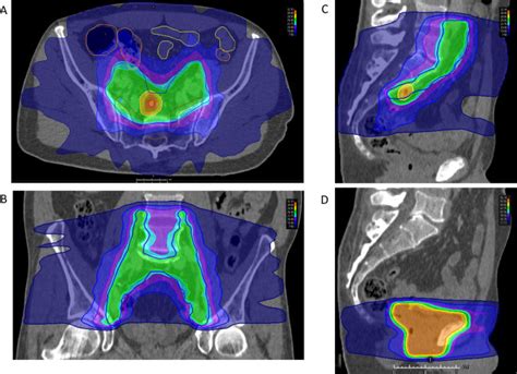 Ultra Hypofractionated Extended Nodal Irradiation Using Volumetric Modulated Arc Therapy For