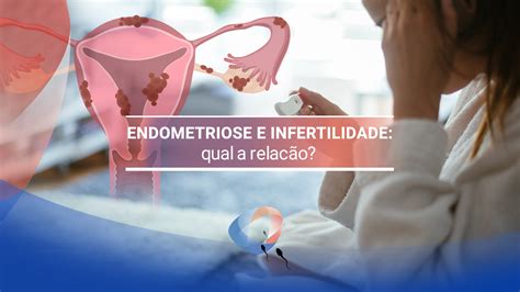 Endometriose E Infertilidade Qual A Rela O Dr Augusto Bussab