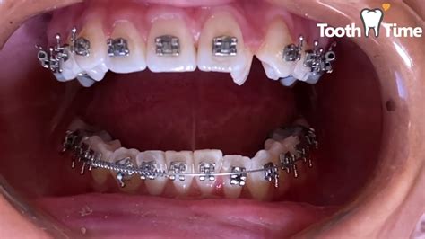 Braces Regular Check Ups Two Coil Springs 3 Months In Braces