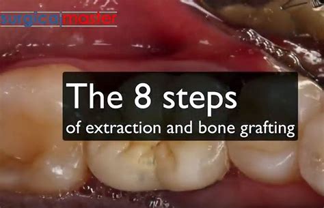 The 8 Steps Of Extraction And Bone Grafting Surgical Master