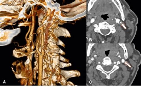 Nascet Method For Measuring Carotid Artery Stenosis Volume Rendered