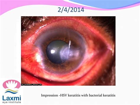 Herpes Simplex Keratitis And Herpes Zoster Opthalmicus Ppt