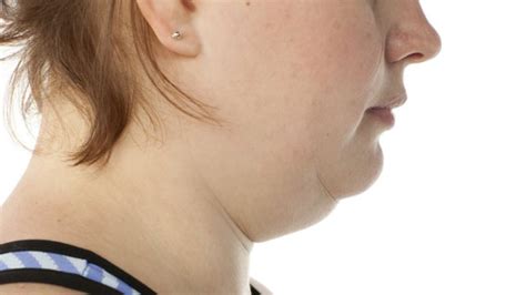 The Home Remedies That Work To Get Rid Of The Unsightly Double Chin