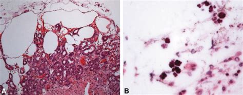 Emphysematous Gastritis Caused By Sarcina Ventriculi Gastrointestinal