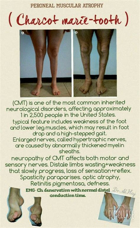 Sensory-Motor Neuropathy Treatment at Christopher Devries blog