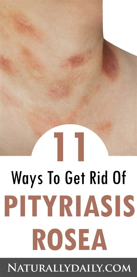 Christmas Tree Rash Pityriasis Rosea