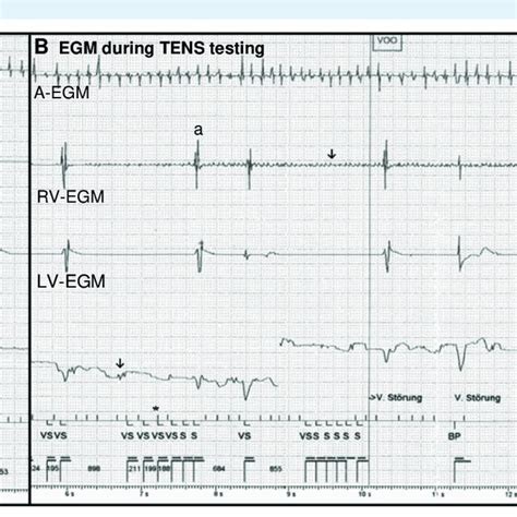 A Baseline Egm Atrial Fibrillation Biventricular Pacing Bp With