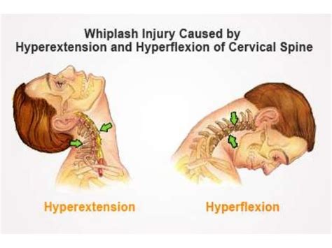 Cervical Spine Injuries And Its Management