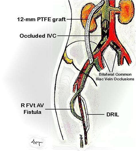 Prophylactic Distal Revascularization And Interval Ligation Procedure