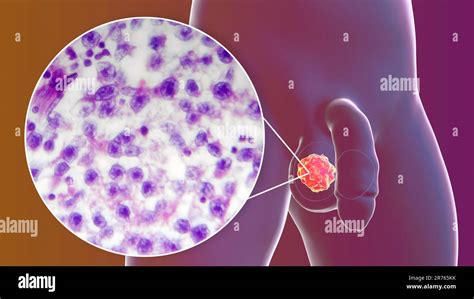 Testicular Cancer A Malignant Spermatocytic Seminoma Computer