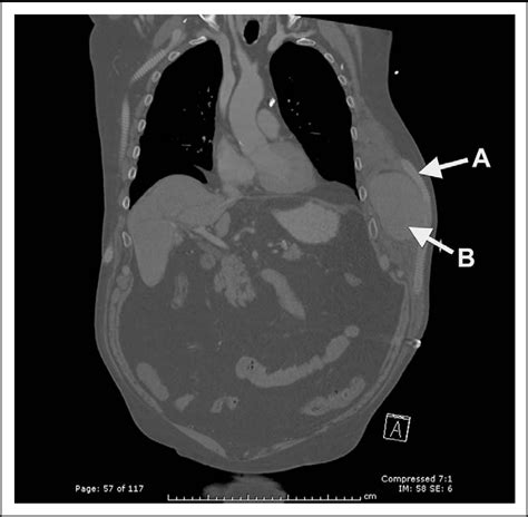 Figure 1 From Traumatic Fracture Of Polytetrafluoroethylene Axillofemoral Bypass Graft