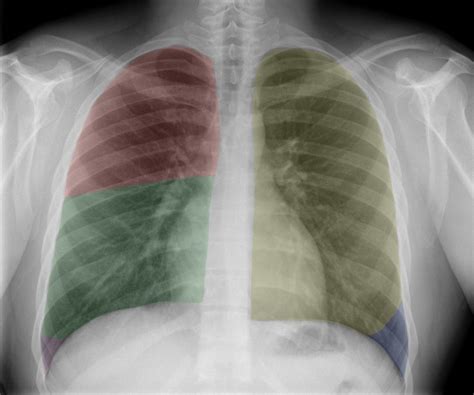 Lateral Chest X Ray Anatomy Anatomical Charts Posters