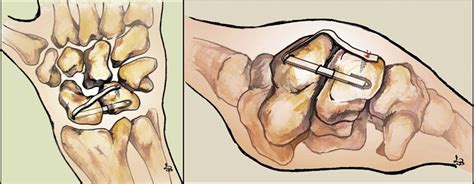 Arthroscopically Assisted Ligamentoplasty For Axial And Dorsal