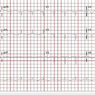 Electrocardiogram Showing Sinus Rhythm With Left Atrial Enlargement