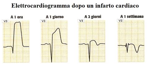 Infarto Miocardico Acuto Ecg E Diagnosi Esami E Analisi Del Sangue