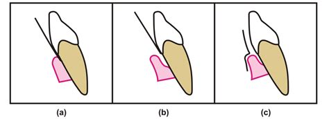 Human Gingival Crevicular Fluids Gcf Proteomics An Overview Pdf