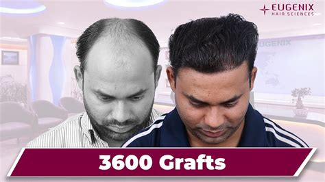 Best Hair Transplant in India: 14 months Hair Transplant result update ...