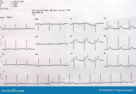 Graph Showing The Results Of The Electrocardiogram Ekg Test On