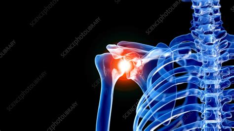 Painful Shoulder Illustration Stock Image F0351980 Science