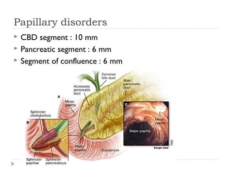 Post cholecystectomy complications | PPT