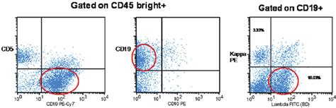 Flow Cytometry Monotypic CD19 Positive B Cells That Have A