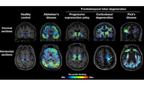 Brain imaging of tau protein in patients with various forms of dementia