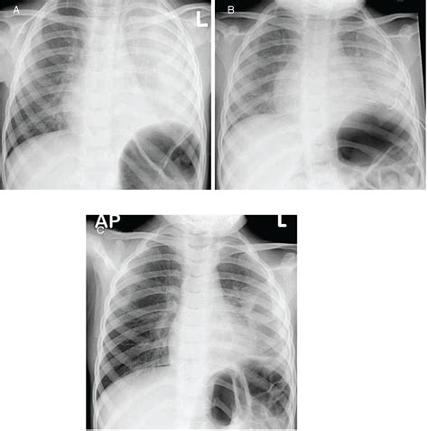 Pleural Empyema Thoracic Key