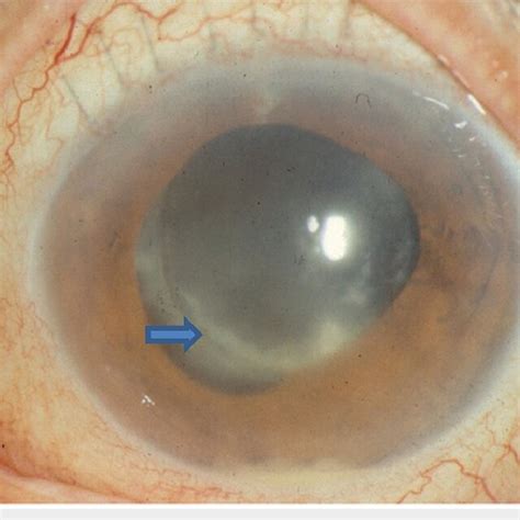 Acute Onset Postoperative Endophthalmitis With Sutured Corneal Wound Download Scientific