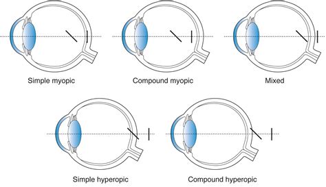 Astigmatism Medical Junction