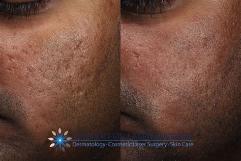 Acne Scar Removal In Washington DC Center For Laser Surgery