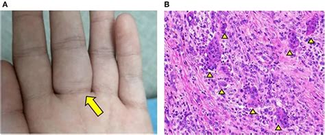 Giant Cell Tumor Of The Tendon Sheath Healthy Food Near Me