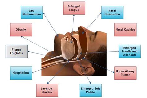 Sleep Apnea Symptoms Causes Prevention And Treatment Zovon