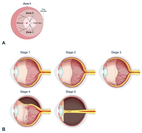 Classification Of Retinopathy Of Prematurity ROP According To Zone