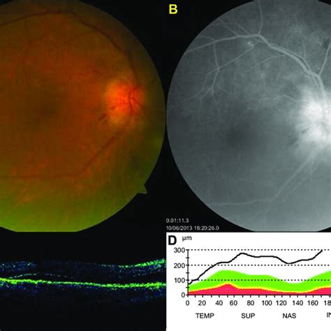 A D At Presentation A Fundus Photography Showing Swollen Optic