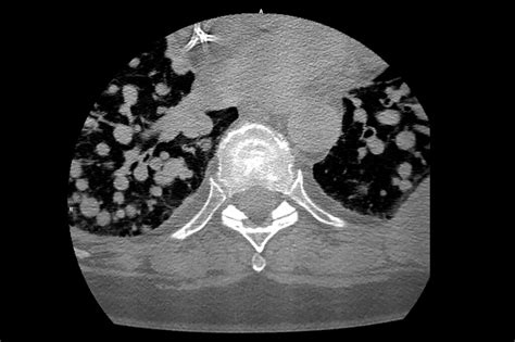 Lung cancer: screening, diagnosis and management - The Pharmaceutical ...