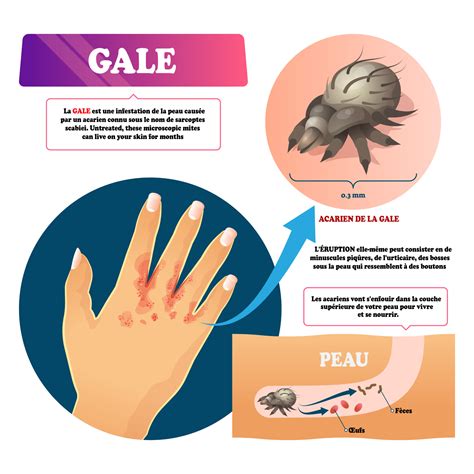 La gale Mode de contamination et Traitements appropriés Information