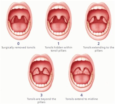 Tonsil Types