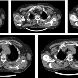 Axial Without Contrast Computed Tomography CT Image Exposed A