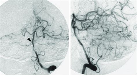 Postoperative Anteroposterior Left And Lateral Right Left Vertebral Download Scientific