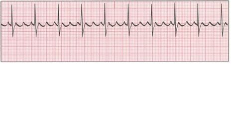 Ekg Strips Flashcards Quizlet