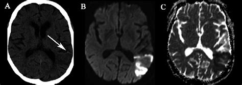 A Ct Brain Demonstrating Loss Of Grey White Matter Interface And Download Scientific Diagram