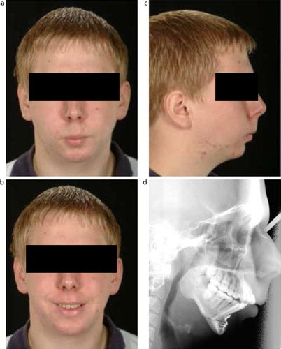 Juvenile Rheumatoid Arthritis Jaw