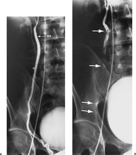 Varicocele And Female Infertility Radiology Key