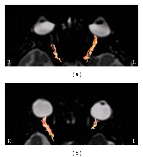 Optic Nerve Dti In Patients With Acute Right A And Left B Optic Download Scientific Diagram