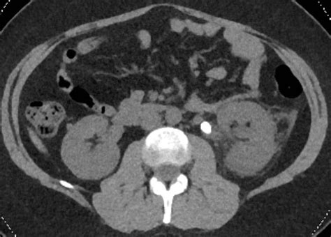 Update Of Dual Energy Ct Applications In The Genitourinary Tract Ajr