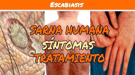 ESCABIOSIS o SARNA HUMANA Síntomas y Tratamiento YouTube