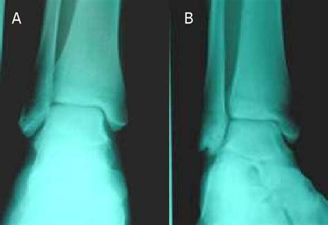 Figure 1 from Os Subfibulare: A case report of painful fibular ...